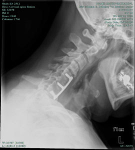 Hey there, take a look at my neck it's a lot like your's. That is if your neck looks anything like mine.  (It actually is my MRI neck picture) MRI image. Copyright 2016. Dick at EFD